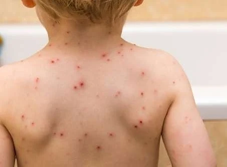 Удар срещу антиваксърите в Ню Йорк - забраниха на неваксинирани деца да излизат навън